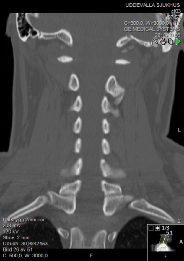 Eine MRT-Aufnahme des Halses eines Mannes mit einem Bruch, auf einem Computerbildschirm angezeigt, zeigt die Größe, Form und Lage des Bruchs.