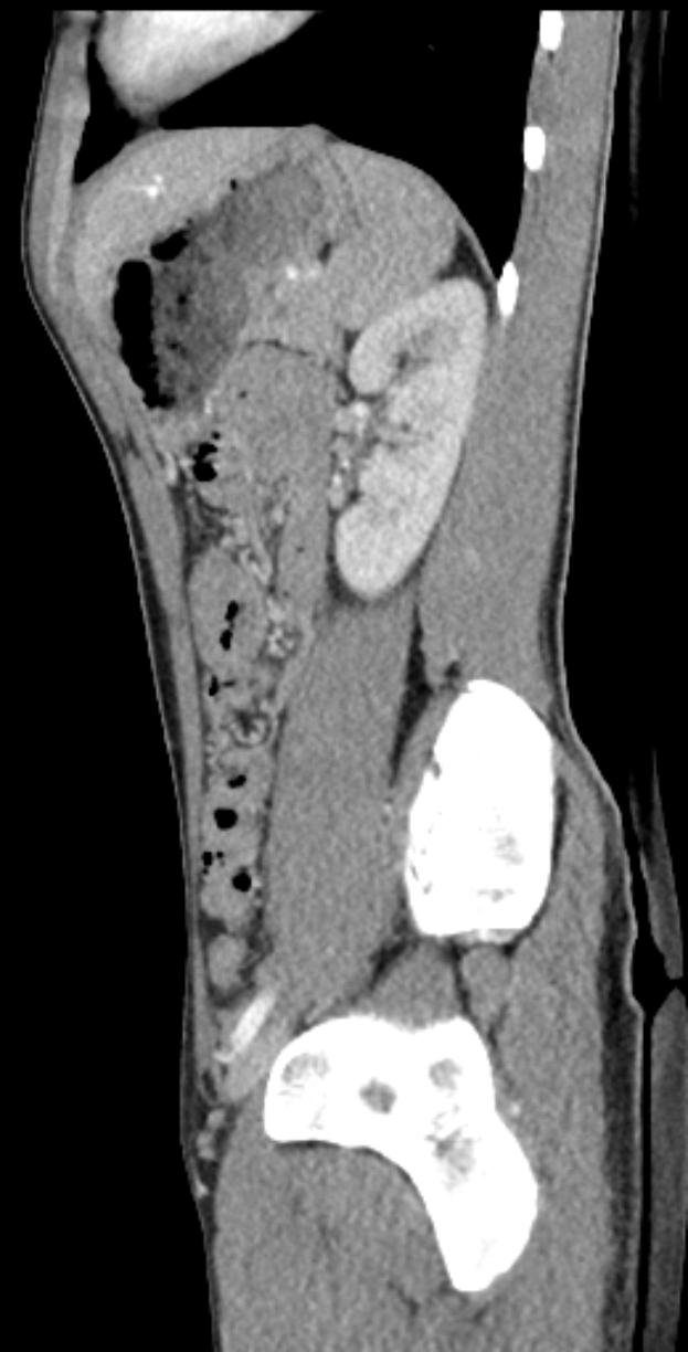 MRT-Aufnahme eines Knies mit einem Bruch in der Mitte, umgeben von einem dunklen Hintergrund.
